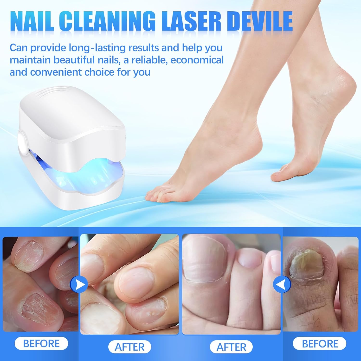 Rechargeable Nail Fungus Treatment for Toenail, Toe Nail Fungal Treatment Nail Fungus Laser Device, Anti-Fungal Nail Treatment for Hand & Feet Infections Remover for Home Use